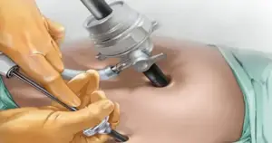 what-is-laparoscopy-for-pregnancy